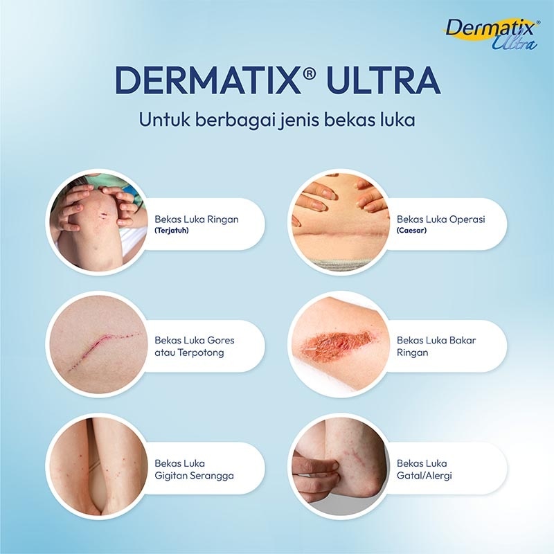 Dermatix Ultra 15g - Merawat dan Memudarkan Bekas Luka