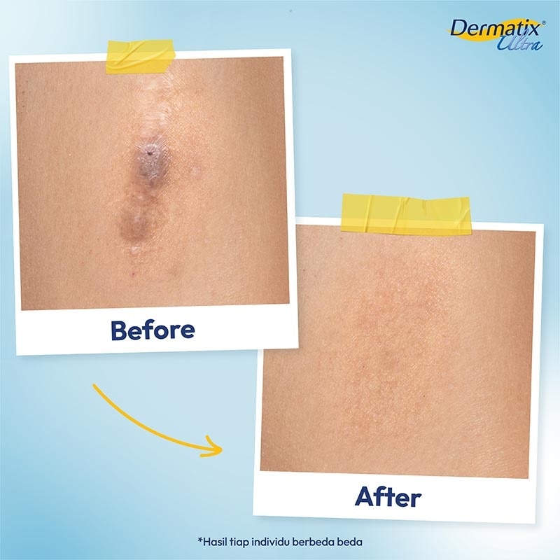 Dermatix Ultra 15g - Merawat dan Memudarkan Bekas Luka