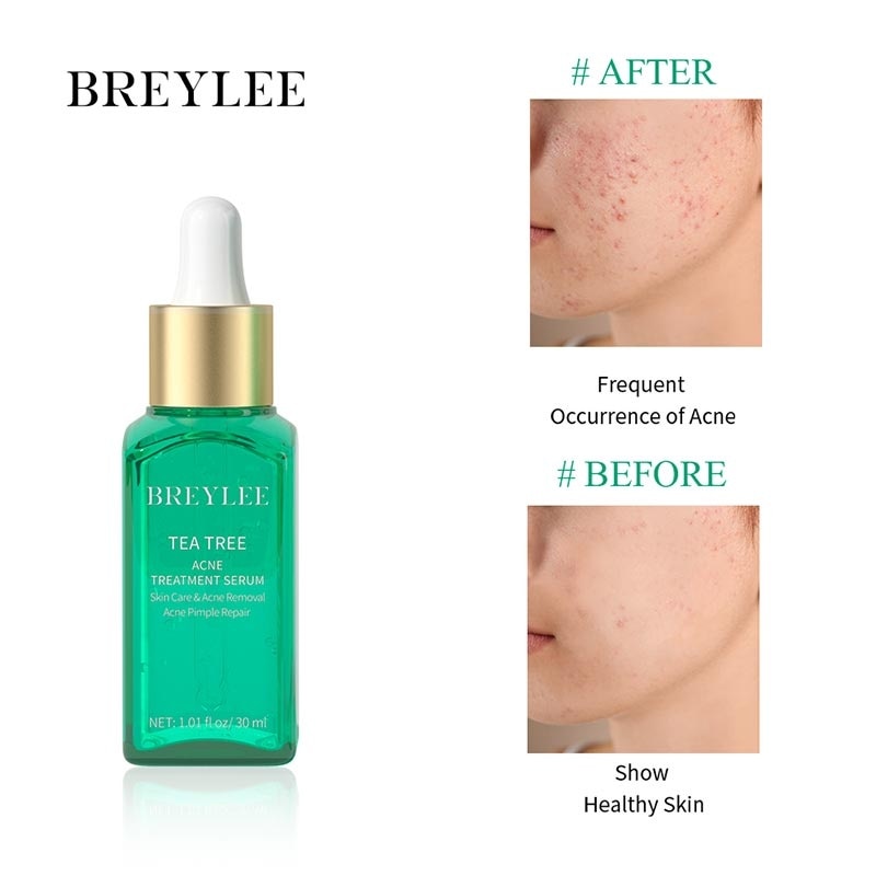 Breylee Acne Treatment Serum 17Ml