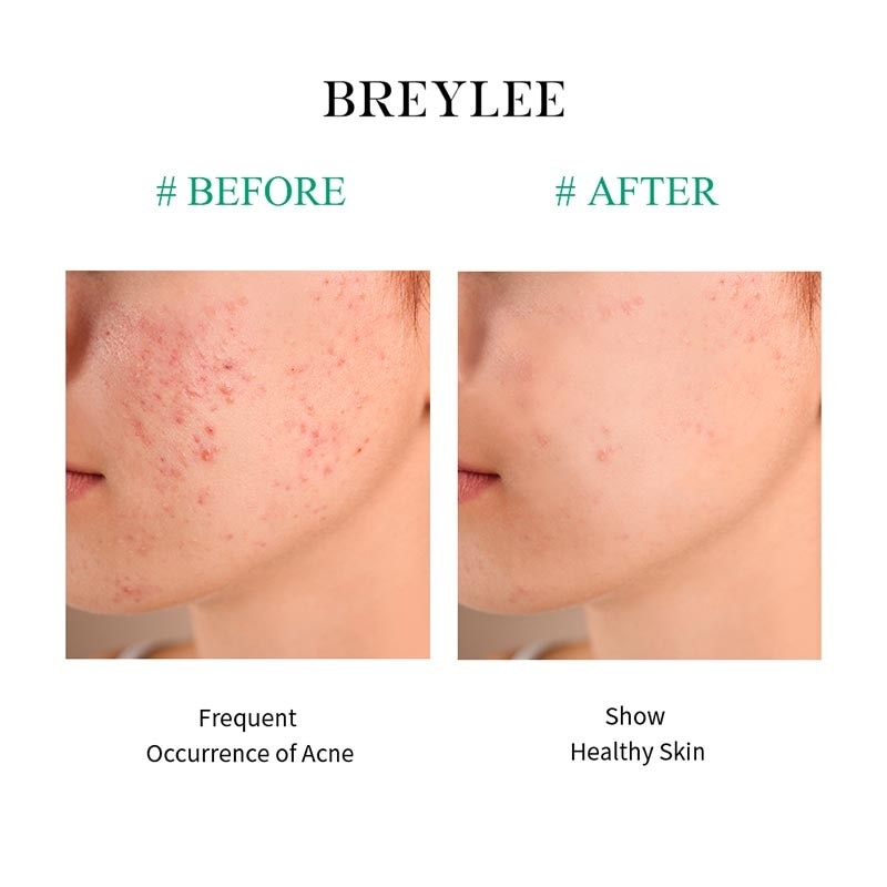 Breylee Acne Treatment Serum 17Ml