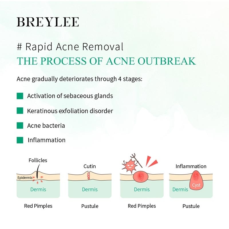 Breylee Acne Treatment Serum 17Ml