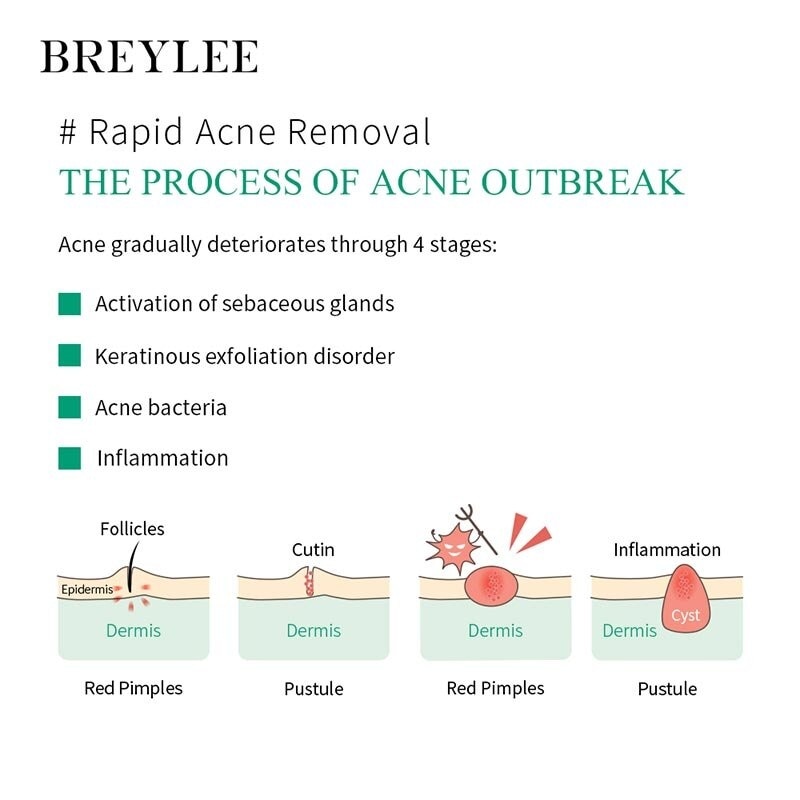 Breylee 0.3 Mm 5G