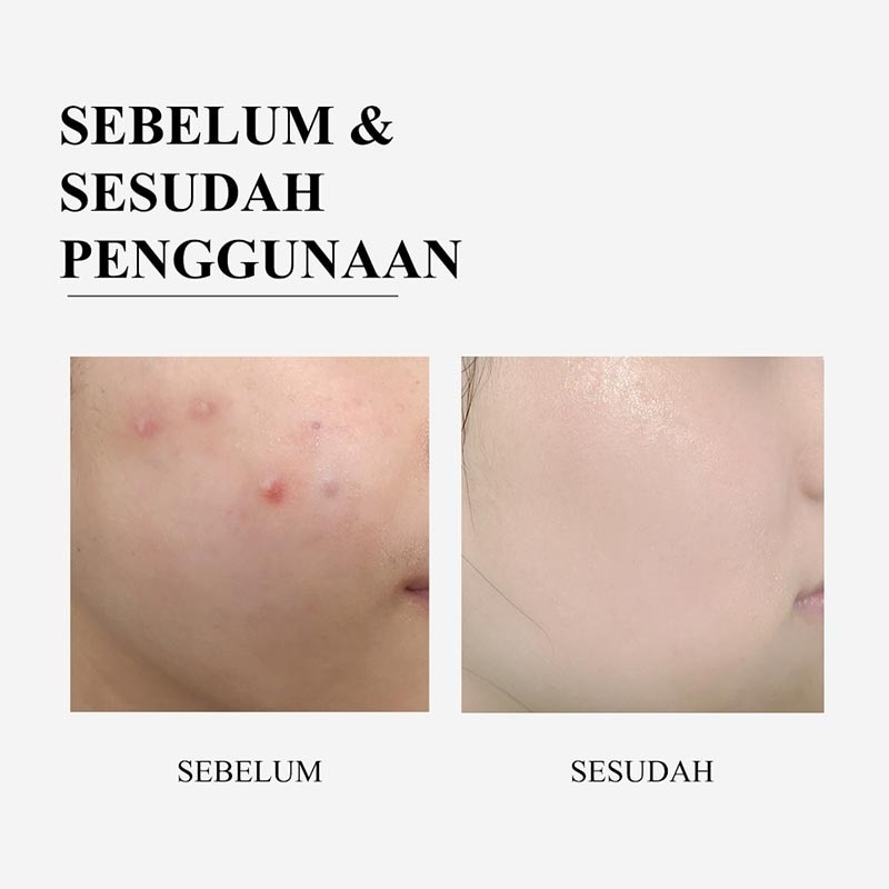 BREYLEE TTREE SAL ACD CLNS PAD 150GR