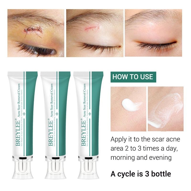 Breylee Acne Cream 30G