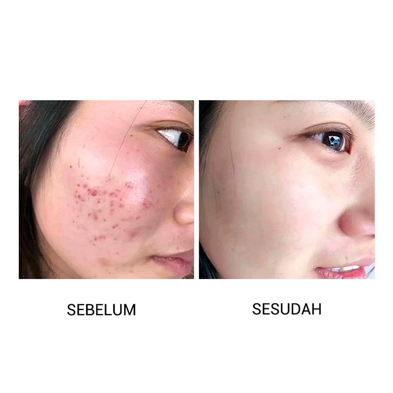 Breylee Acne Treatment 25Ml