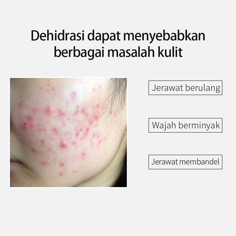 Breylee Acne Treatment 25Ml