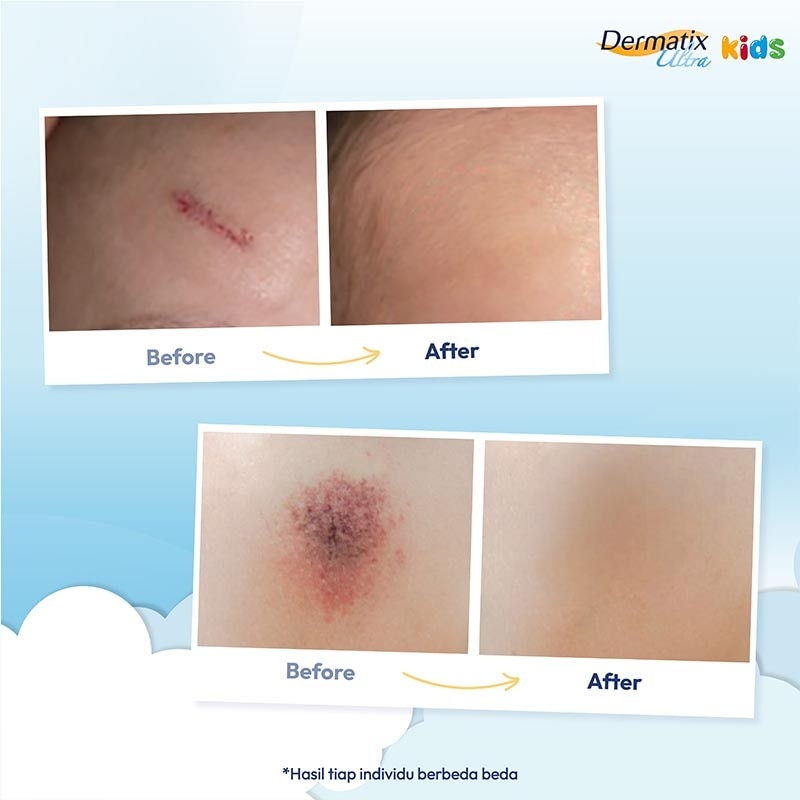 Dermatix Ultra Kids 9g - Merawat dan Memudarkan Bekas Luka Anak