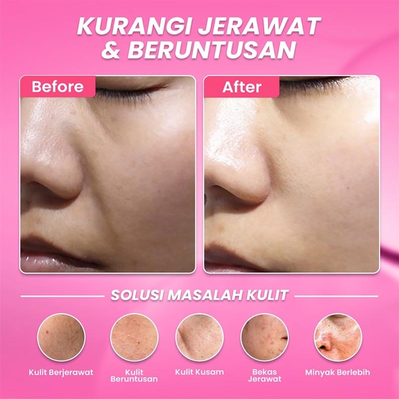 Hanasui Anti Acne Serum Renew 20ml