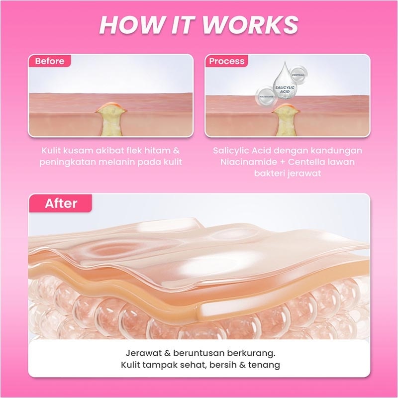 Hanasui Anti Acne Serum Renew 20ml