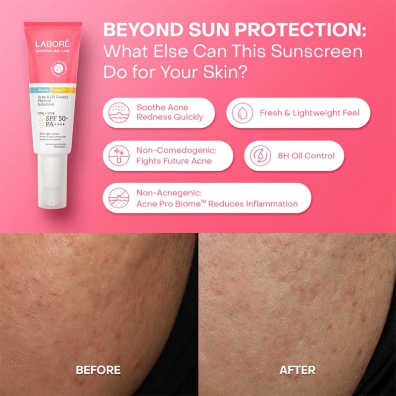 [Best Sunscreen by US Dermatologist] Acne Oil Correct Physical Sunscreen SPF 50+/PA++++ 10ml