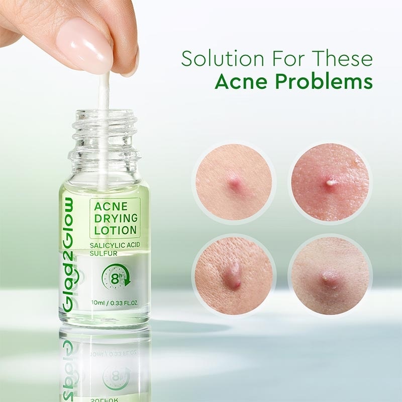 Glad2Glow Acne Drying Lotion 10ml