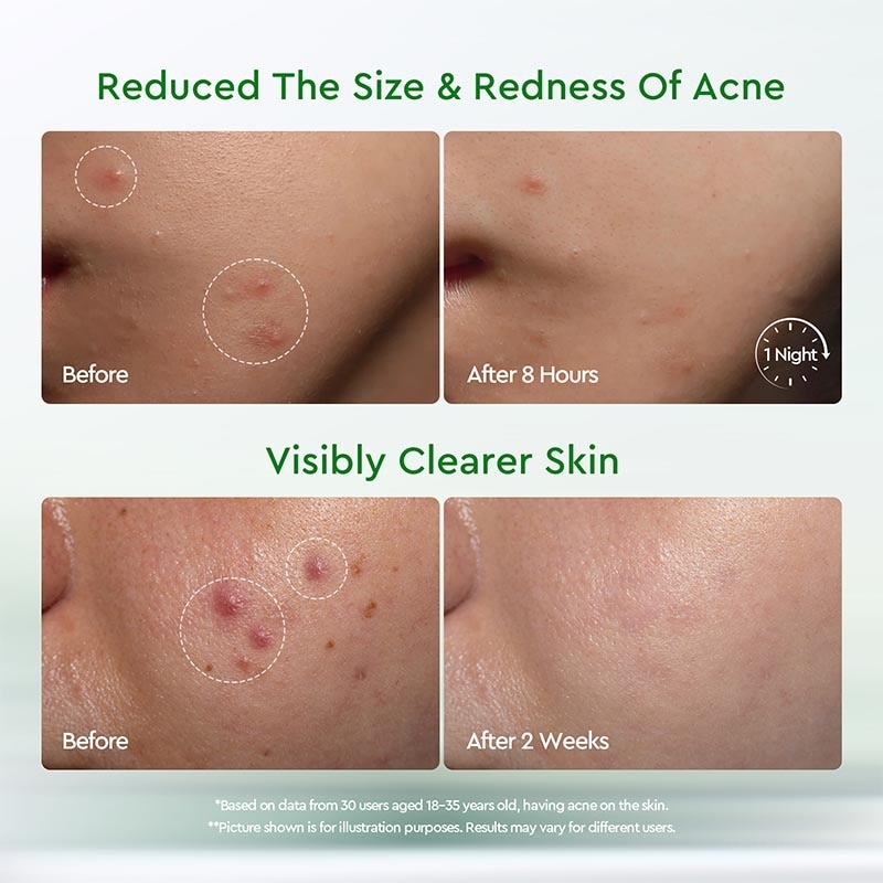 Glad2Glow Acne Drying Lotion 10ml