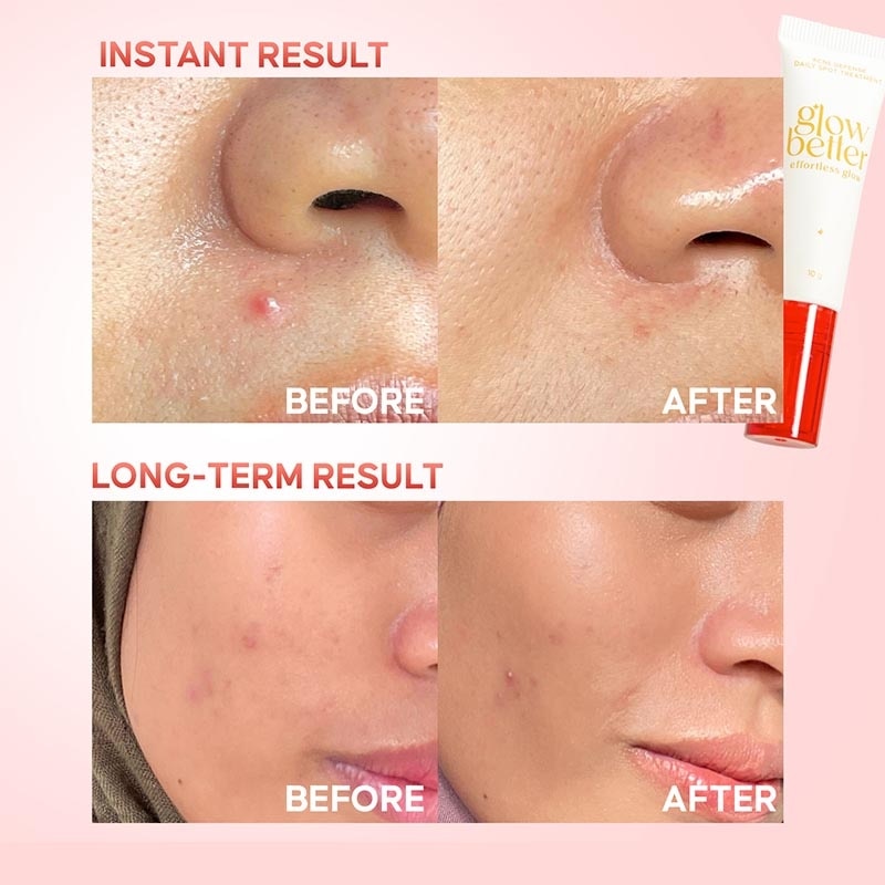 Glow Better Effortless Glow Acne Defense Daily Spot Treatment 10g