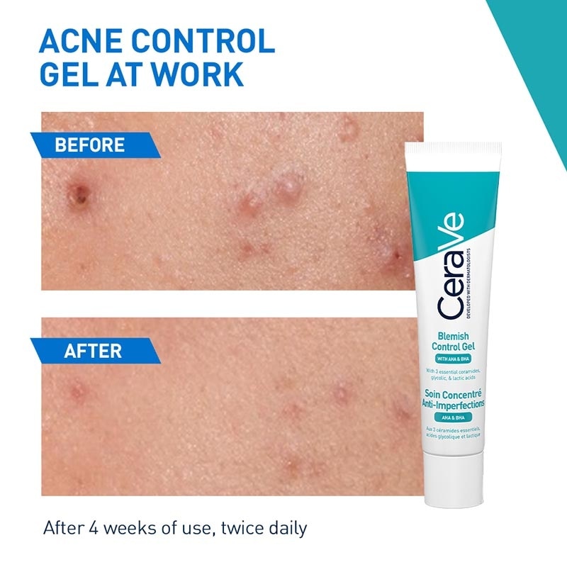 CeraVe Blemish Control Gel 40ml - Gel moisturizer for Acne Prone Skin