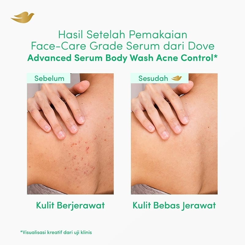 Advanced Serum Acne Control Body Wash 300g