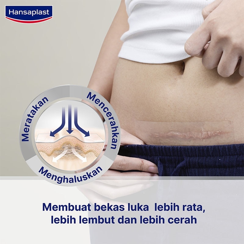 Plester Bekas Luka XL 21'S