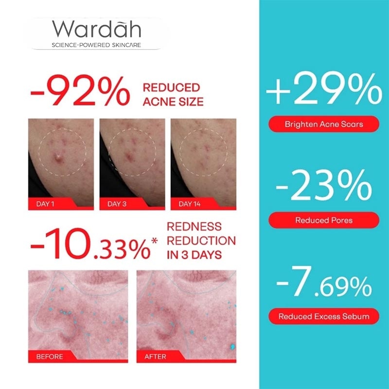 Acne Serum Acnederm Relief Serum 20ml